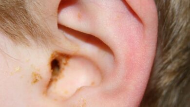 Nguyên nhân và những dấu hiệu gây viêm tai ngoài ở trẻ là gì?