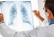 Phương pháp trị ung thư phổi mới tại Singapore