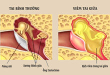 Viêm tai giữa có tự khỏi được không và bao lâu thì khỏi?